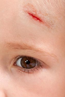 Causas-de-los-accidentes-en-la-edad-infantil